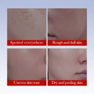 Four-panel image showing skin concerns addressed by SADOER Niacinamide & Vitamin C Anti-Freckle Face Cream.