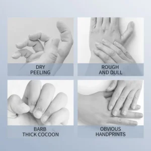 Dry, peeling, and rough hands addressed by SADOER Goat Milk Nicotinamide Hand Mask.